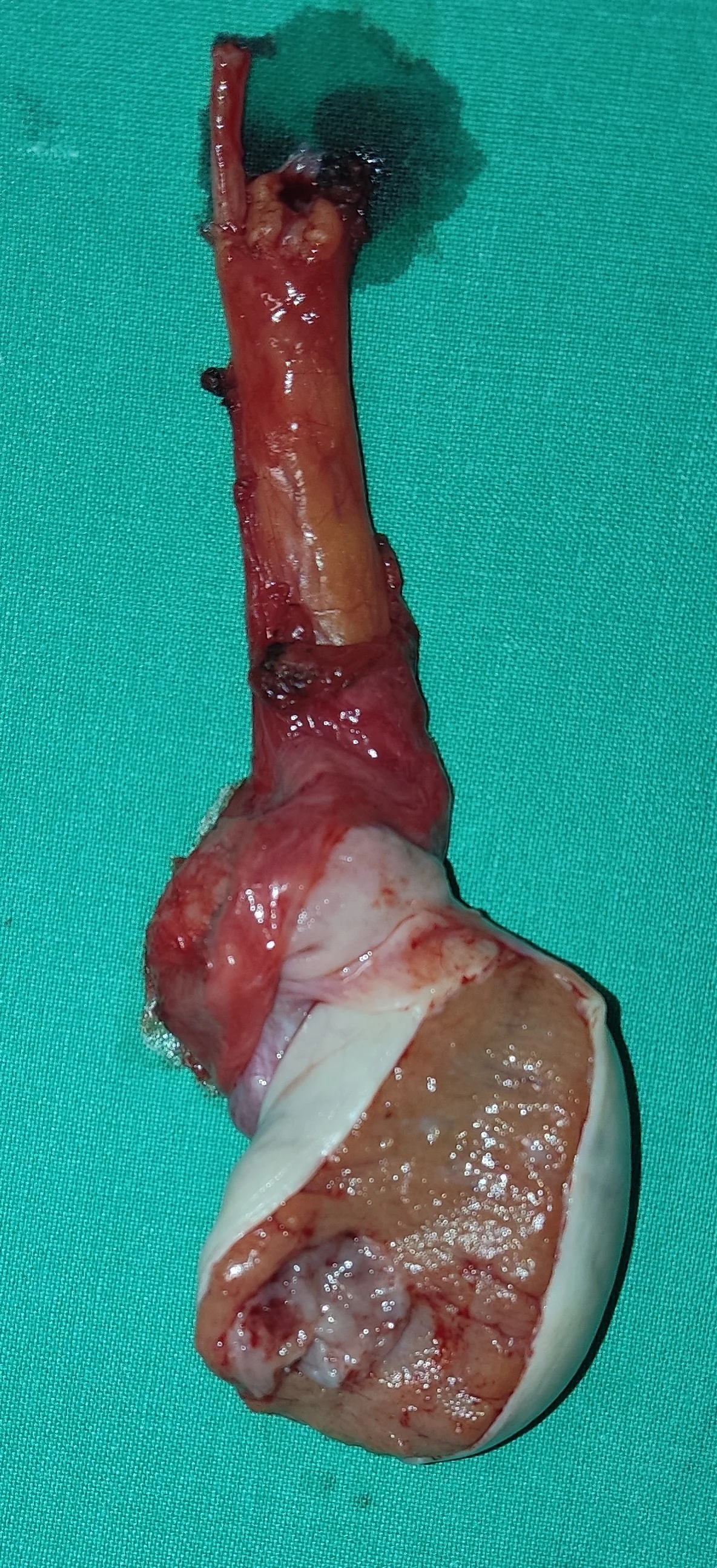 MIXED TESTICULAR TUMOR