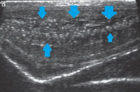 MONDOR'S DISEASE - PENILE DORSAL VEIN THROMBOSIS