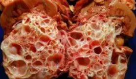 MULTICYSTIC NEPHROMA