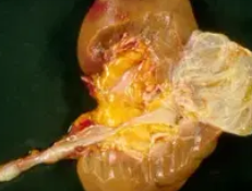MULTICYSTIC NEPHROMA