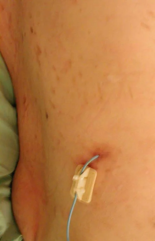 NEPHROSTOMY CATHETER