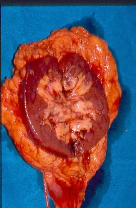 RENAL CARCINOMA