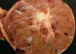 ONCOCYTOMA