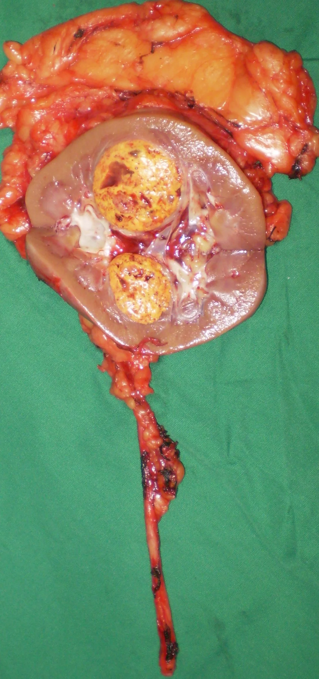 RENAL CARCINOMA