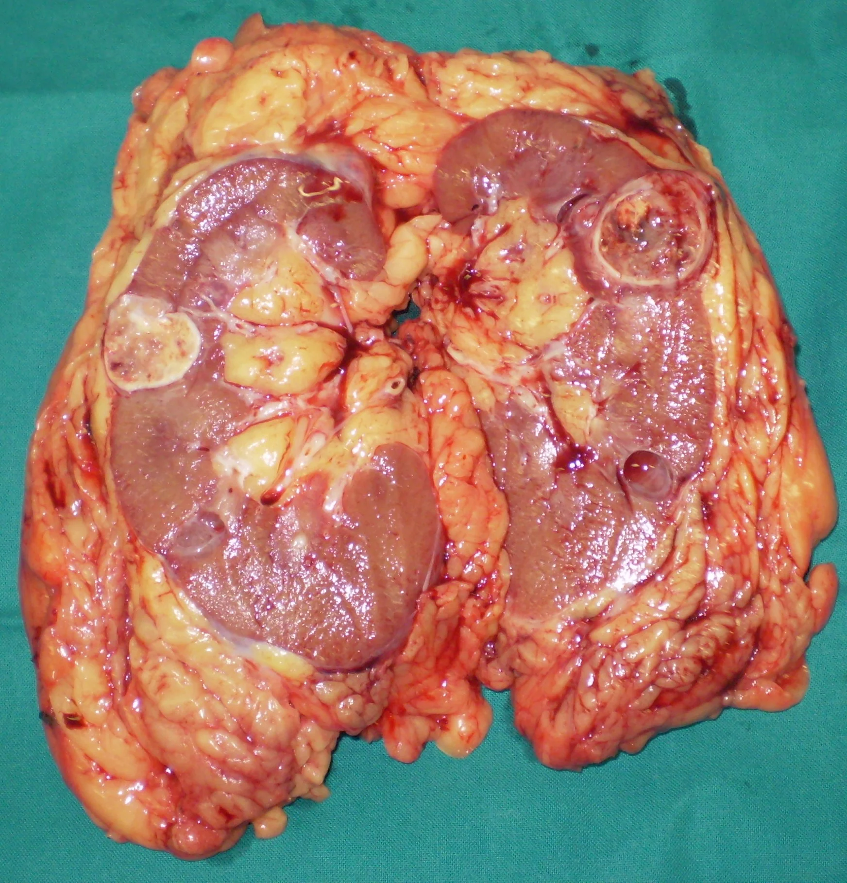 RENAL CARCINOMA
