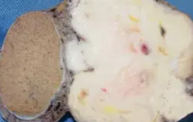 PARATESTICULAR LEIOMYOSARCOMA