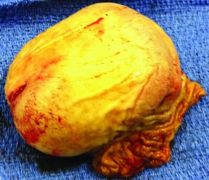 PENECTOMY 