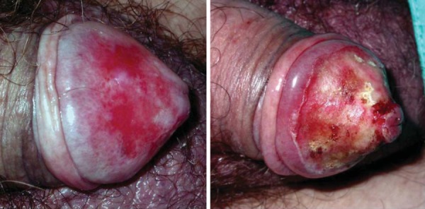 PENILE CARCINOMAS