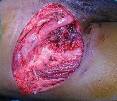 PENILE CARCINOMA - INGUINAL LYMPHADENECTOMY