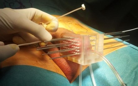 PENILE CARCINOMA - BRACHYTHERAPY