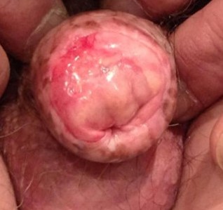 PENILE CARCINOMA