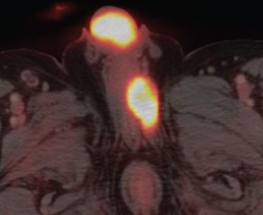 PENILE CARCINOMA