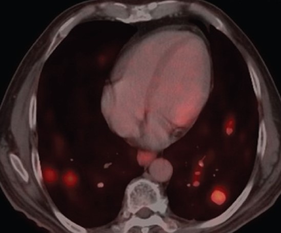 PENILE CARCINOMA - PULMONARY METASTASES