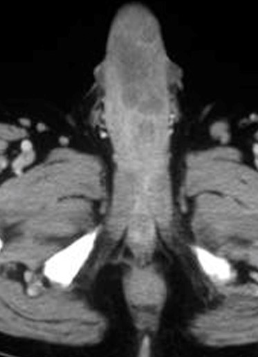 PENILE CARCINOMA