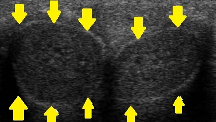 PENILE ECHO-NORMAL