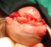 PENILE EPIDERMOID CYST 