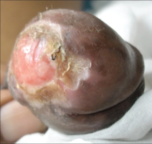 PENILE HYPERKERATOTIC PLAQUE 