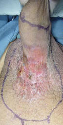 PENILE PAGET'S DISEASE