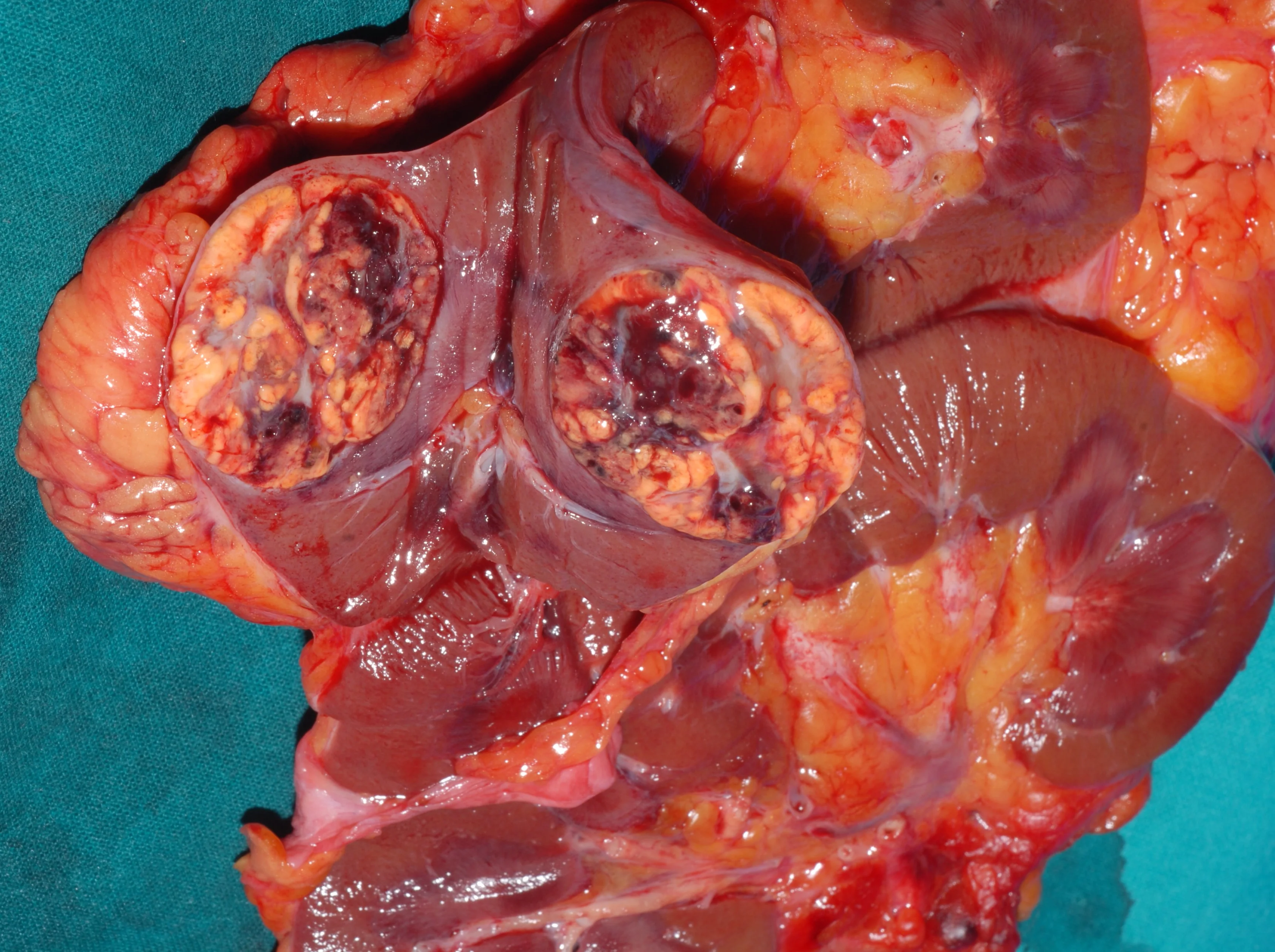 RENAL CARCINOMA