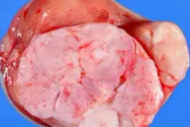 POST PUBERTAL TERATOMA