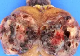 POST PUBERTAL TERATOMA 