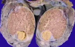 PRE PUBERTAL TERATOMA