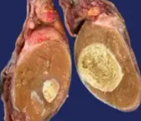 PRE PUBERTAL TERATOMA 