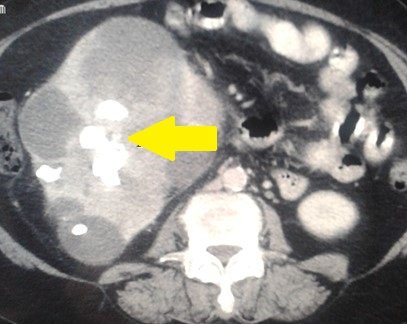 PRIMARY SQUAMOUS RENAL CELL CARCINOMA