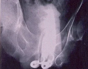PENILE PROSTHESIS