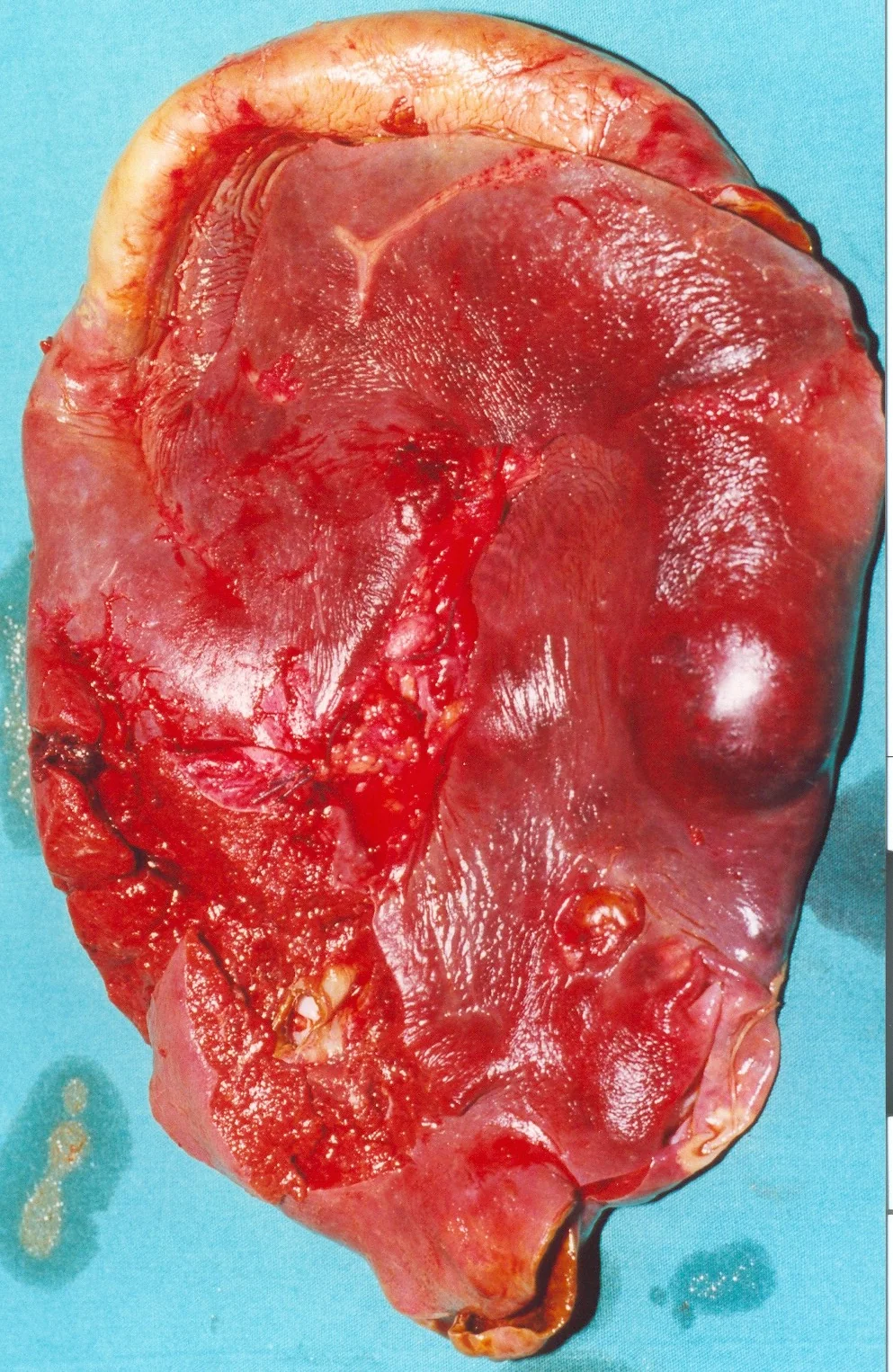 PYONEPHROSIS - NEPHRECTOMY