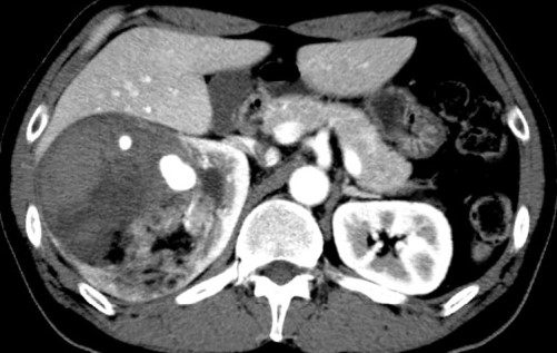 RENAL ANGIOMYOLIPOMA