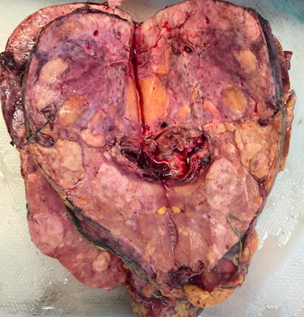 RENAL ANGIOMYOLIPOMA 