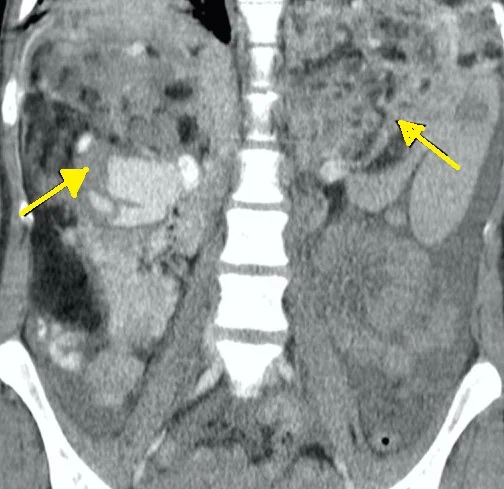 BILATERAL ANGIOMYOLIPOMAS