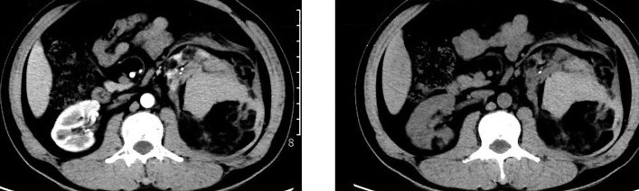 RENAL ANGIOMYOLIPOMA 