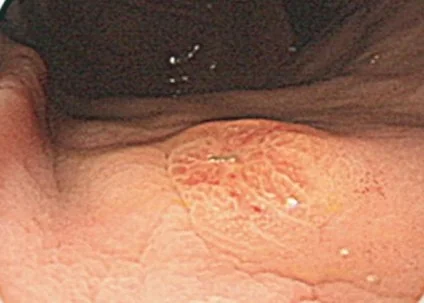 RENAL CARCINOMA - GASTRIC METASTASIS