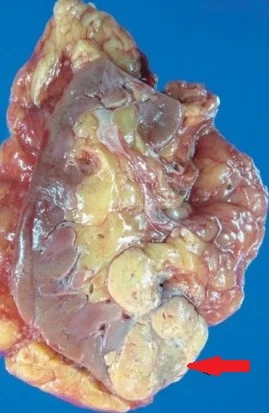 RENAL CARCINOMA