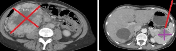 RENAL CARCINOMA - SPLEEN METASTASIS
