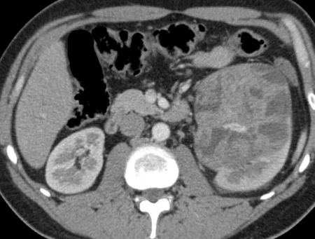 RENAL LEIOMYOMA 