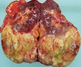 RENAL LEIOMYOSARCOMA 