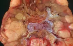 RENAL LYMPHOMA