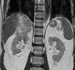RENAL MASS INVADING LIVER 
