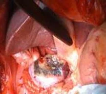RENAL MASS INVADING LIVER - PARTIAL NEPHRECTOMY