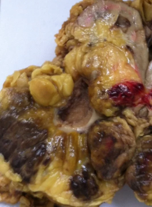 RENAL MYELOLIPOMA