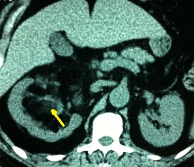 RENAL MYELOLIPOMA 