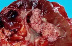 RENAL PELVIS CARCINOMA