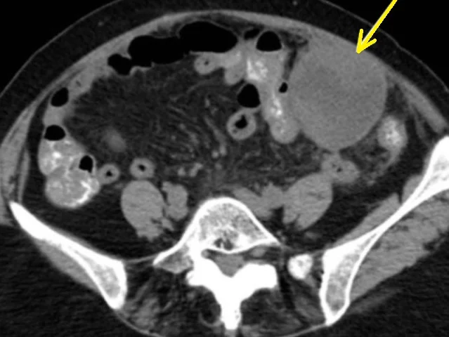 SARCOMATOID RENAL CELL CARCINOMA 