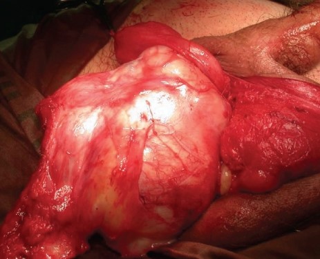 SCROTAL ANGIOMYXOMA