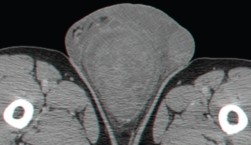 SCROTAL ANGIOMYXOMA 