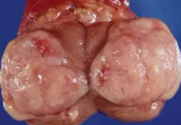 SEMINOMA 