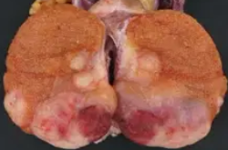 SEMINOMA 